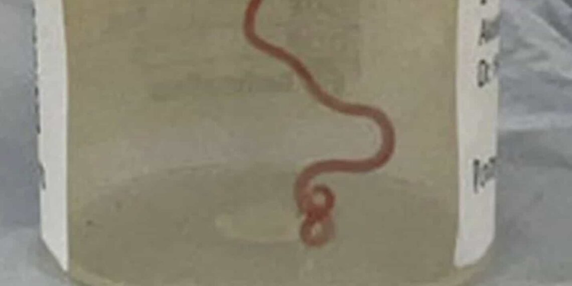 Los médicos que operaron a la mujer se quedaron sorprendidos ya que nunca habían visto algo así.