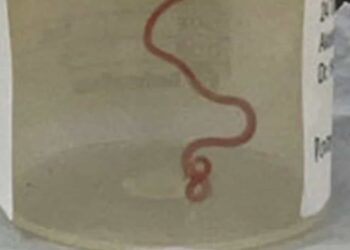 Los médicos que operaron a la mujer se quedaron sorprendidos ya que nunca habían visto algo así.