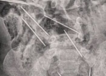 El bebé tuvo que ser intervenido quirúrgicamente debido a lo complicado de la situación.