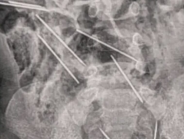 El bebé tuvo que ser intervenido quirúrgicamente debido a lo complicado de la situación.