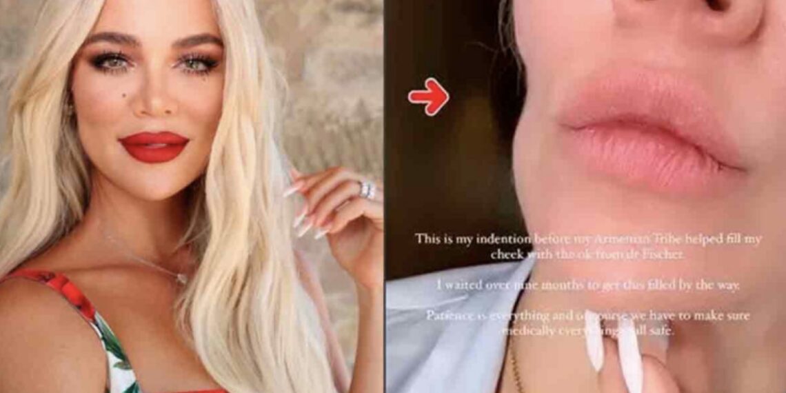 Khloe Kardashian que ahora se somete a inyecciones estéticas para disimular la marca que le dejó la cirugía para extirparle tipo raro de cáncer en la mejilla