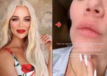 Khloe Kardashian que ahora se somete a inyecciones estéticas para disimular la marca que le dejó la cirugía para extirparle tipo raro de cáncer en la mejilla