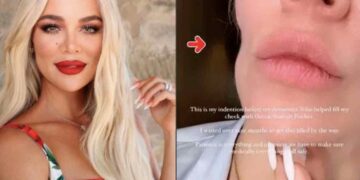 Khloe Kardashian que ahora se somete a inyecciones estéticas para disimular la marca que le dejó la cirugía para extirparle tipo raro de cáncer en la mejilla