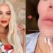 Khloe Kardashian que ahora se somete a inyecciones estéticas para disimular la marca que le dejó la cirugía para extirparle tipo raro de cáncer en la mejilla
