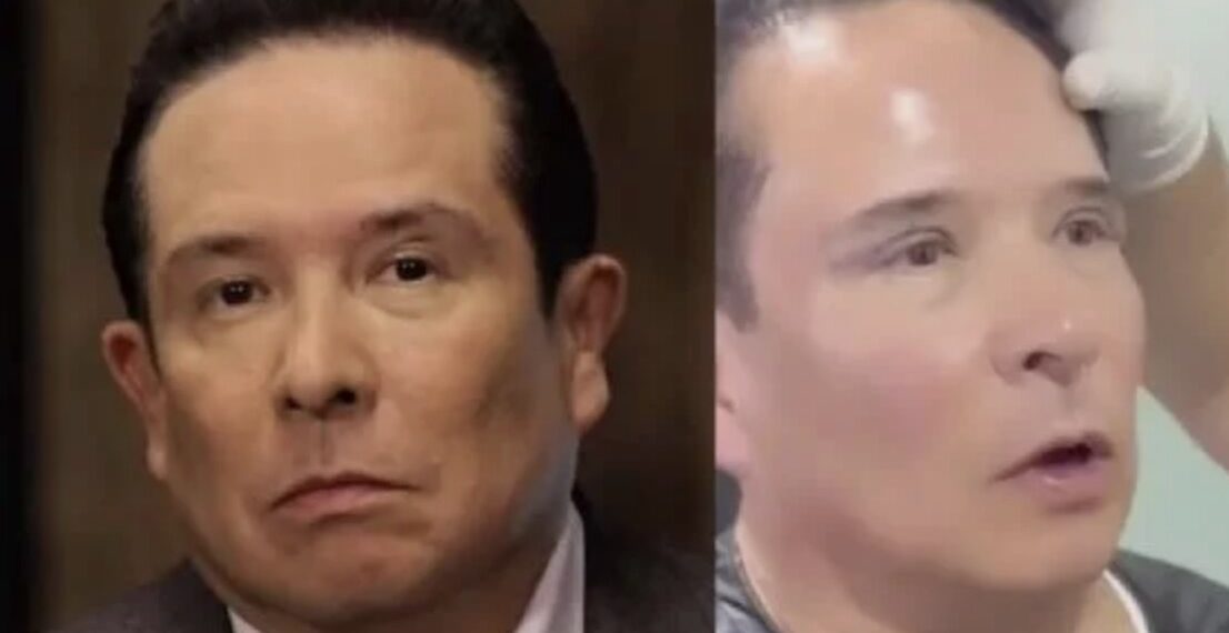 El conductor de televisión Gustavo Adolfo Infante, fiel amante de las cirugías estéticas, habla sin tapujos, muestra el cambio y las cicatrices en su rostro.