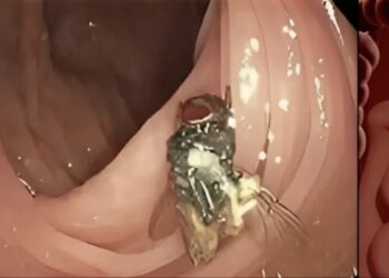 Los médicos realizaban una colonoscopia cuando se percataron del insecto.