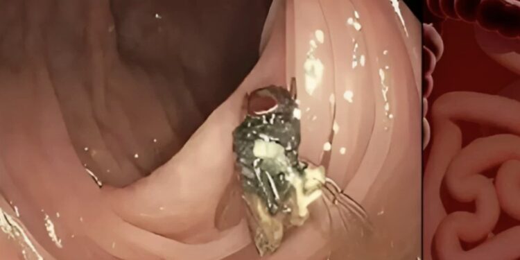 Los médicos realizaban una colonoscopia cuando se percataron del insecto.
