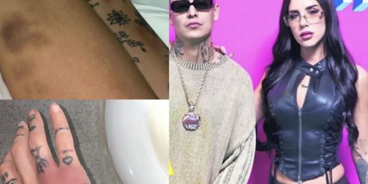 Akasha publicó en sus redes sociales imágenes de los golpes que recibió al parecer del rapero mexicano Alemán.