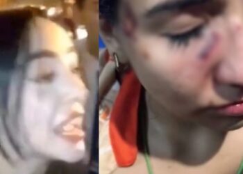 La joven relató que fue llevada a emergencias tras recibir un golpe en el ojo por el que tuvo que recibir cinco puntadas