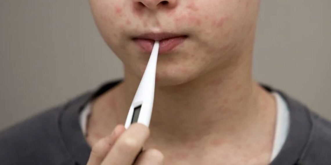 El menor de cuatro años presentaba exantema maculopapular en cabeza y tórax, así como conjuntivitis, tos y fiebre.