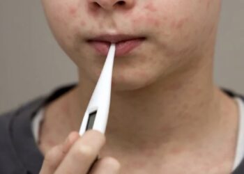 El menor de cuatro años presentaba exantema maculopapular en cabeza y tórax, así como conjuntivitis, tos y fiebre.