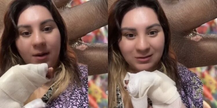 La mujer dijo estar incapacitada tras sufrir una quemadura de segundo grado en toda su mano.