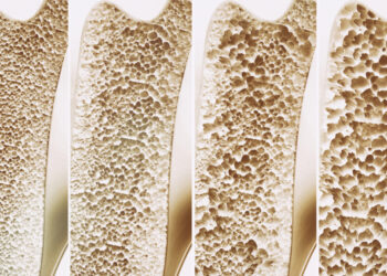 Osteoporosis 4 stages in one picture - 3d rendering