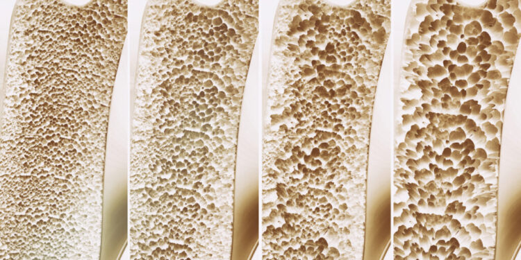 Osteoporosis 4 stages in one picture - 3d rendering